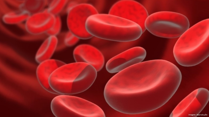 Anemia